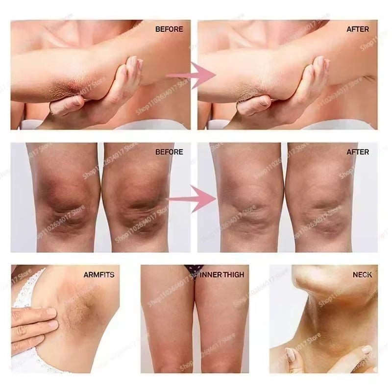 Hot~Whitening Cream Private Parts Underarm Bleaching Serum Whiten Butt Knee Brighten Inner Thigh Intimate Parts Dark Remove Mela - MacroPanora
