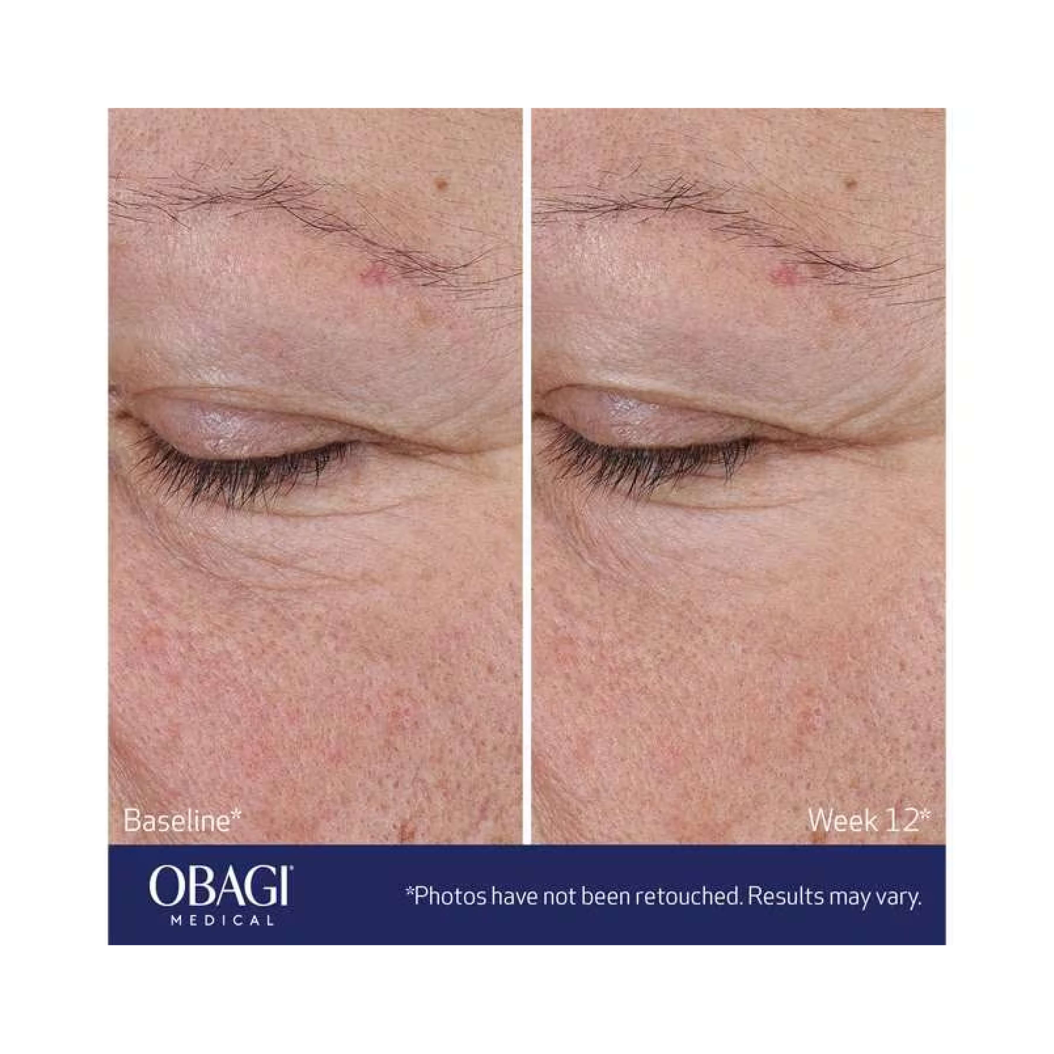Obagi ELASTIderm® Advanced Filler Concentrate - Eyes, Neck & Lips | MacroPanora