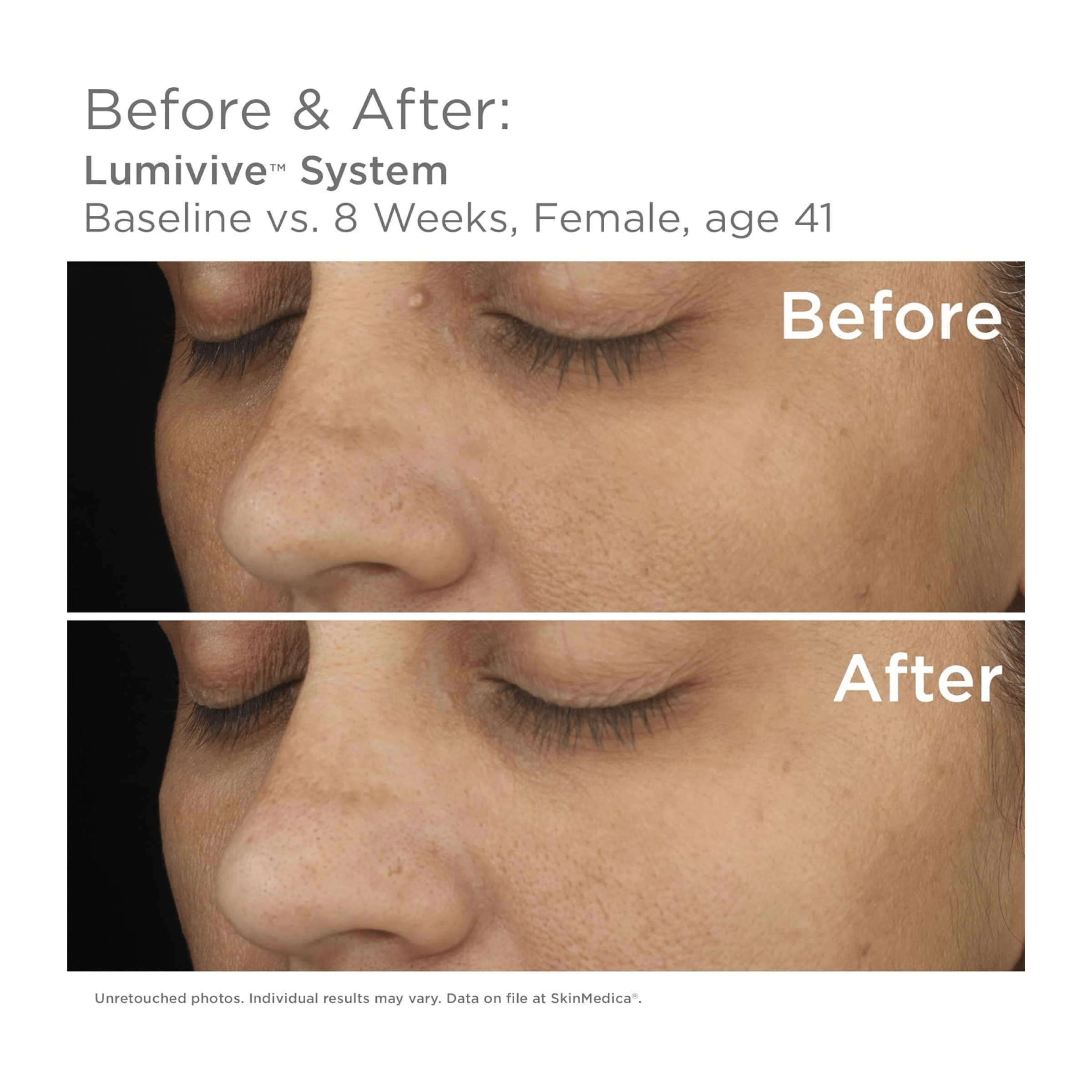 SkinMedica Lumivive™ System - Programs & Kits | MacroPanora