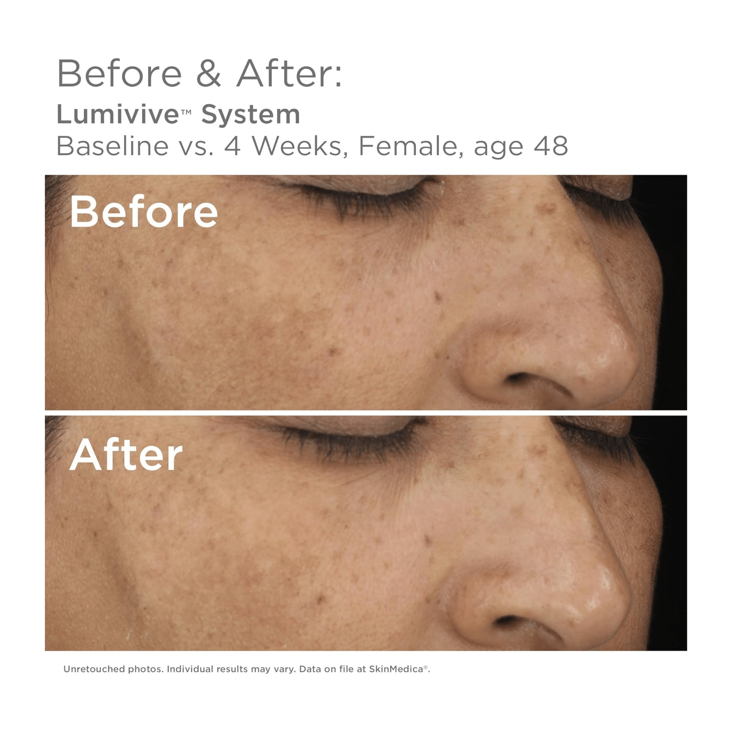 SkinMedica Lumivive™ System - Programs & Kits | MacroPanora